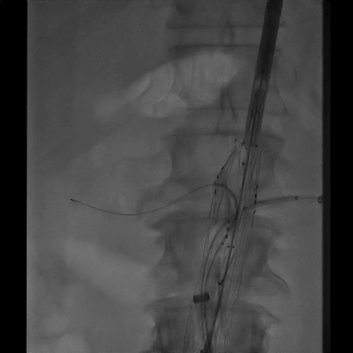 Example fluoroscopy image